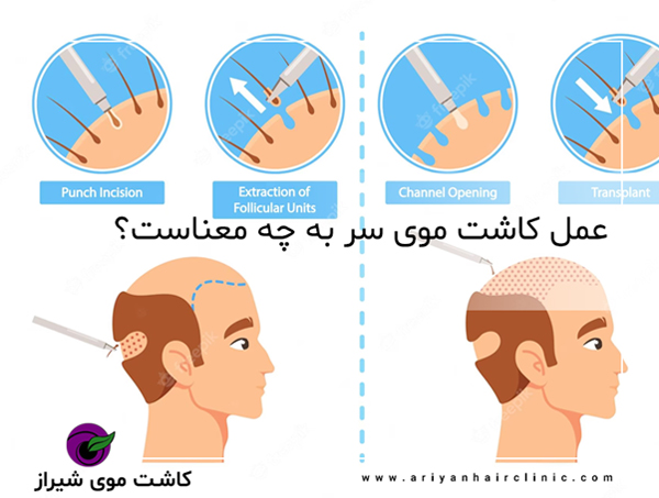 عمل کاشت موی سر به چه معناست؟