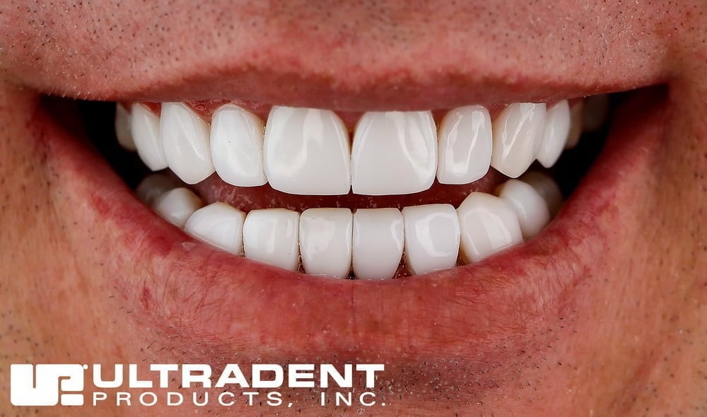 کامپوزیت دندان آمریکایی (الترادنت)