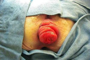 بیرون زدگی مقعدی چیست و چگونه آن را درمان کنیم؟