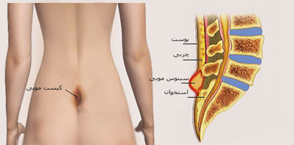 آیا راهی برای درمان کیست مویی بدون جراحی وجود دارد؟