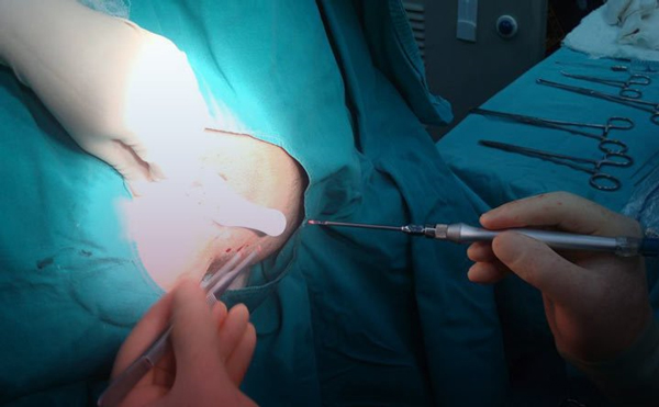 جراحی و درمان آبسه مقعدی با لیزر