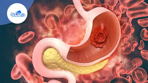 تغذیه برای سرطان معده؛ پس از تشخیص سرطان معده چه بخوریم و چه نخوریم؟