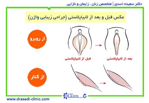 جراحی لابیاپلاستی