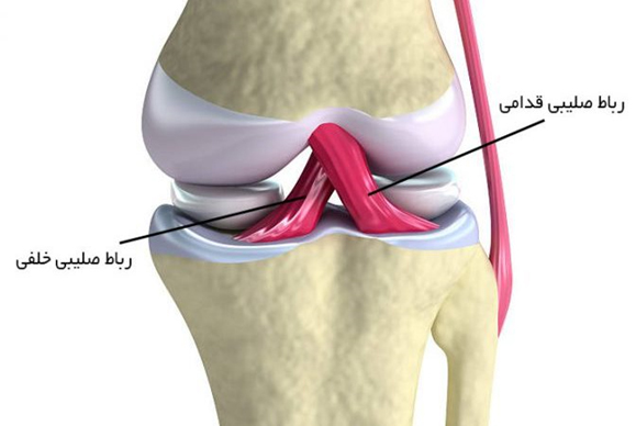 پارگی رباط صلیبی زانو