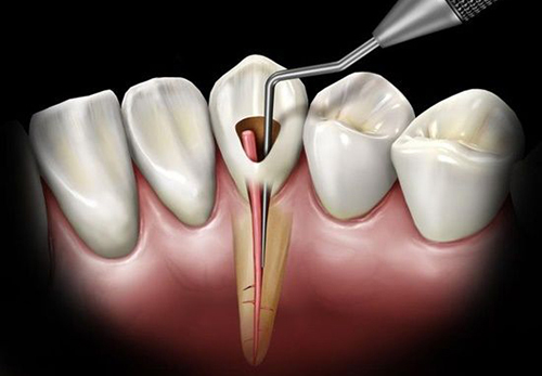 نشانه های نیاز به درمان ریشه دندان چیست؟