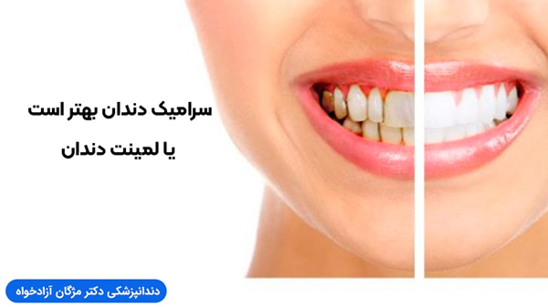 سرامیک دندان بهتر است یا لمینت دندان