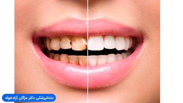 تفاوت سرامیک دندان با لمینت دندان