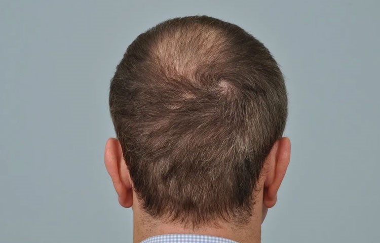 راهکارهای نوین برای کاشت مو با بانک موی ضعیف