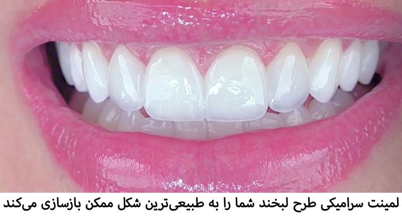 لمینت سرامیکی طرح لبخند شما را به طبیعی ترین شکل ممکن بازسای می کند