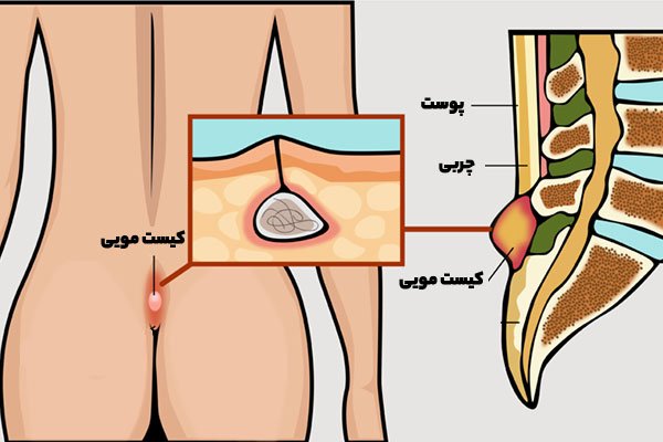 درمان درد کیست مویی