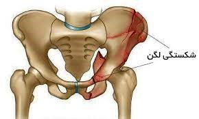 درمان شکستگی لگن