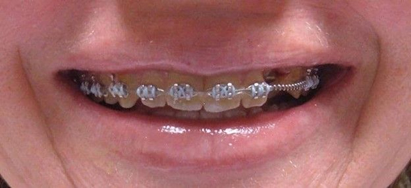 ارتودنسی و ایمپلنت: آیا می توان با ایمپلنت دندان را ارتودنسی کرد؟