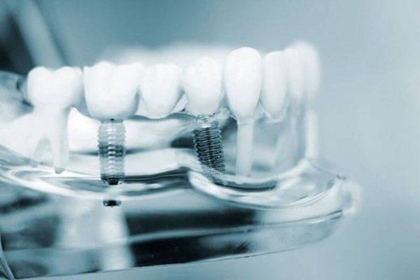 ارتودنسی و ایمپلنت: آیا می توان با ایمپلنت دندان را ارتودنسی کرد؟