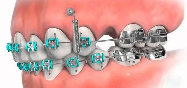 ارتودنسی و ایمپلنت: آیا می توان با ایمپلنت دندان را ارتودنسی کرد؟