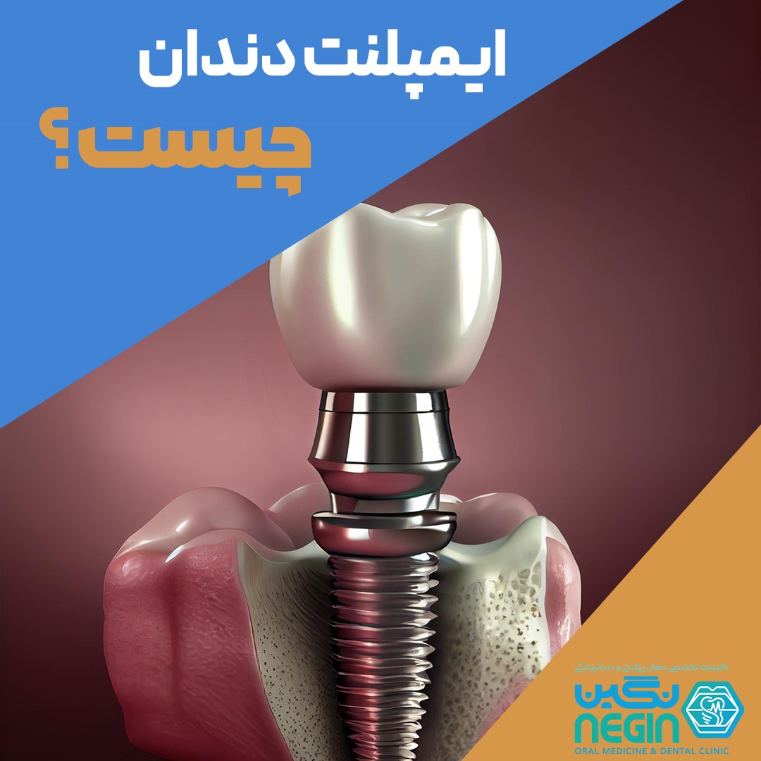 ایمپلنت دندان چیست؟