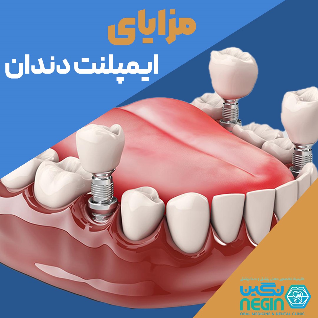 مزایای ایمپلنت دندان