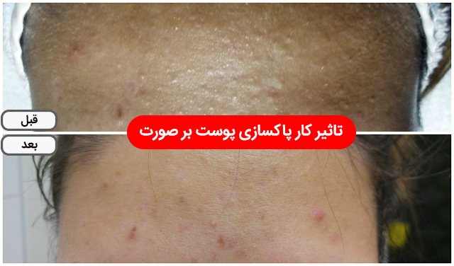 تاثیر کار پاکسازی پوست بر صورت