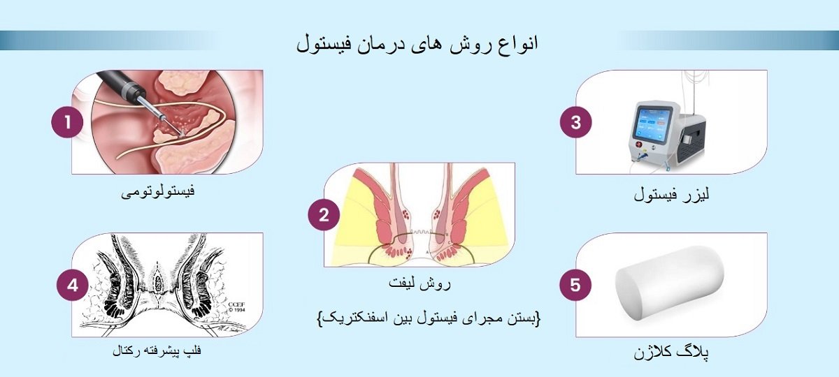 انواع روش های درمان فیستول