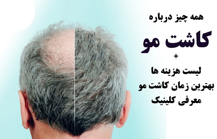 همه چیز درباره کاشت مو + لیست هزینه ها و بهترین زمان کاشت مو معرفی کلینیک