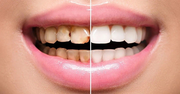 زیبایی دهان و دندان؛ بررسی انواع جراحی ها و روش ها