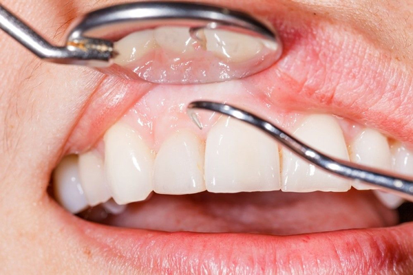 زیبایی دهان و دندان؛ بررسی انواع جراحی ها و روش ها