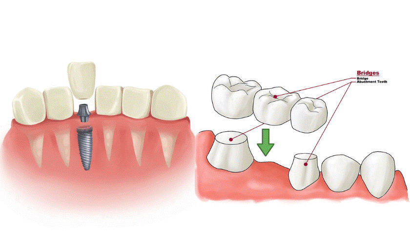 هزینه ایمپلنت