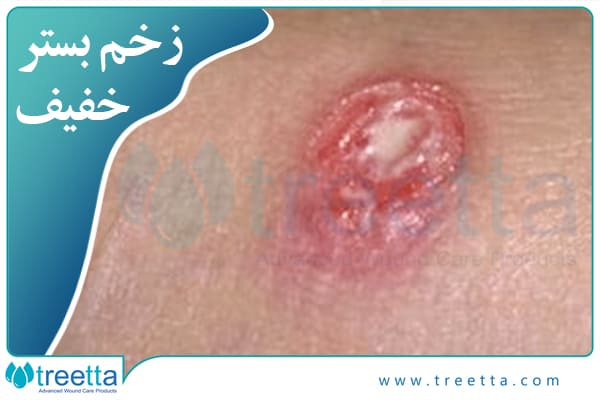 زخم بستر خفیف