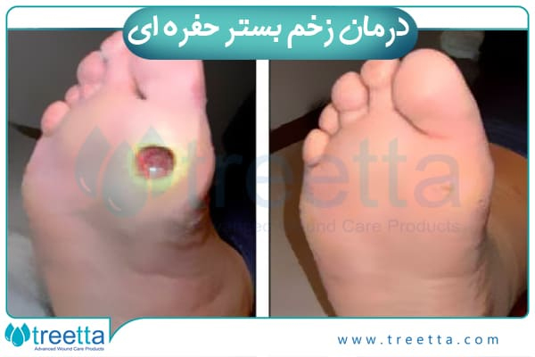 درمان زخم بستر حفره ای