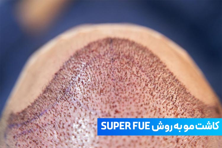 کاشت مو به روش SUPER FUE