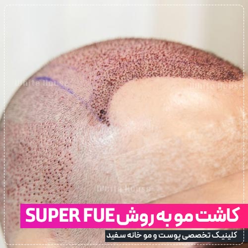 کاشت مو به روش SUPER FUE